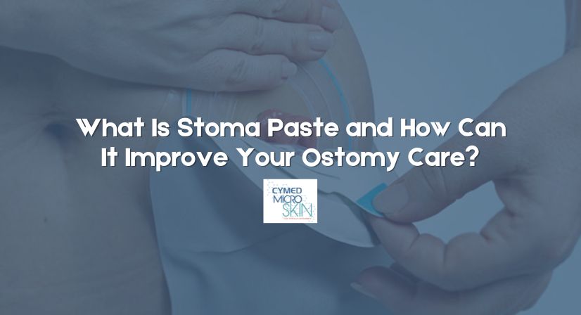 What Is Stoma Paste and How Can It Improve Your Ostomy Care